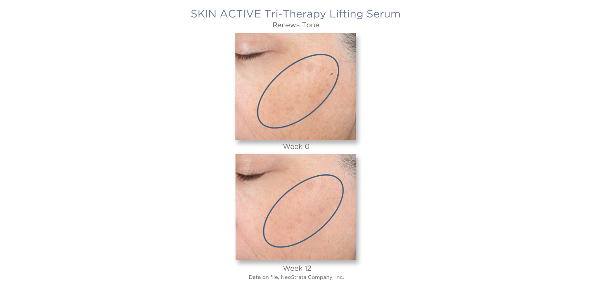 Neostrata Tri-therapy Lifting Serum 30 ml. (3)