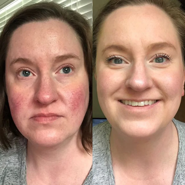 Rosalique anti-redness cream  - gegn rósroða 30 ml. (6)