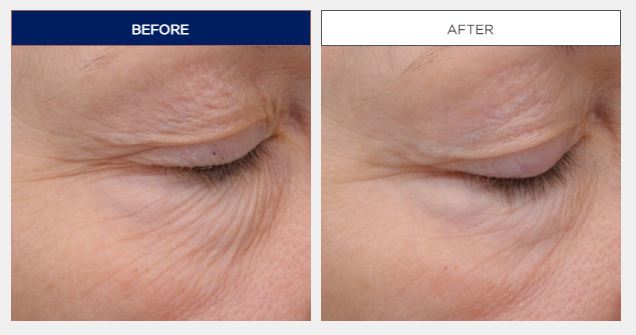 Neostrata Skin Active Intensive Eye Therapy 15 ml. (1)