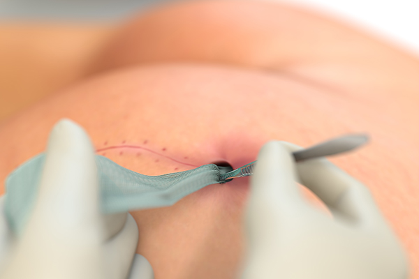 Sorbact Ribbon grisja 10x200 cm., 1 stk. (2)