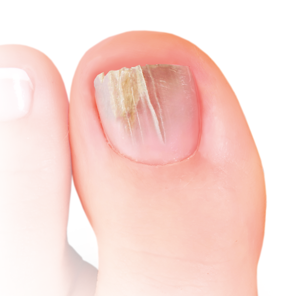 Trimb Nailner Bursti 2 in1 við naglasvepp (1)