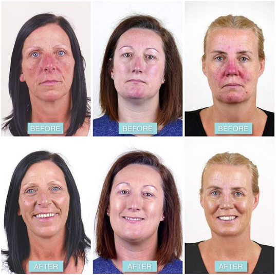 Rosalique anti-redness cream  - gegn rósroða 30 ml. (1)